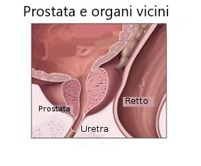 L'idrossitirosolo dell'Extravergine contrasta il tumore alla prostata