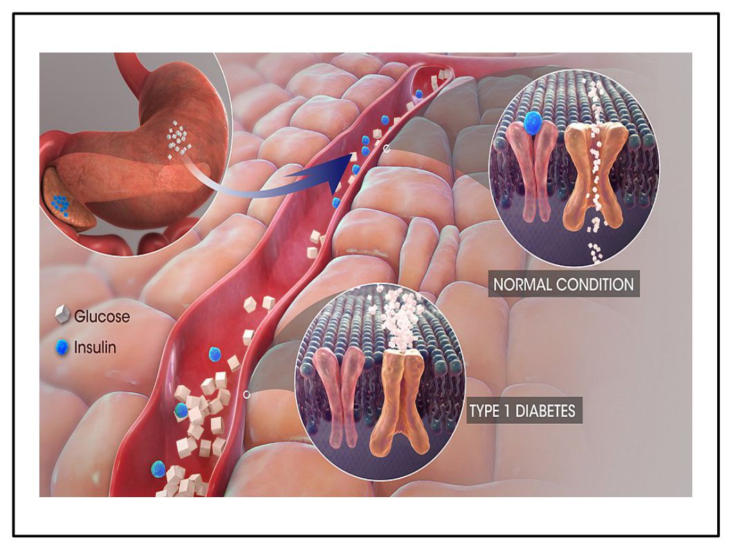 L’Extravergine nella dieta dei pazienti diabetici riduce la necessità dell’uso di farmaci