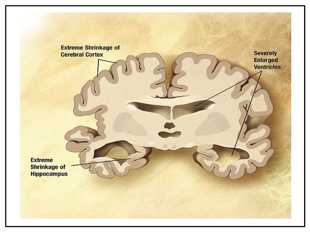 L'Extravergine di Oliva protegge il Cervello ripulendolo dalle scorie