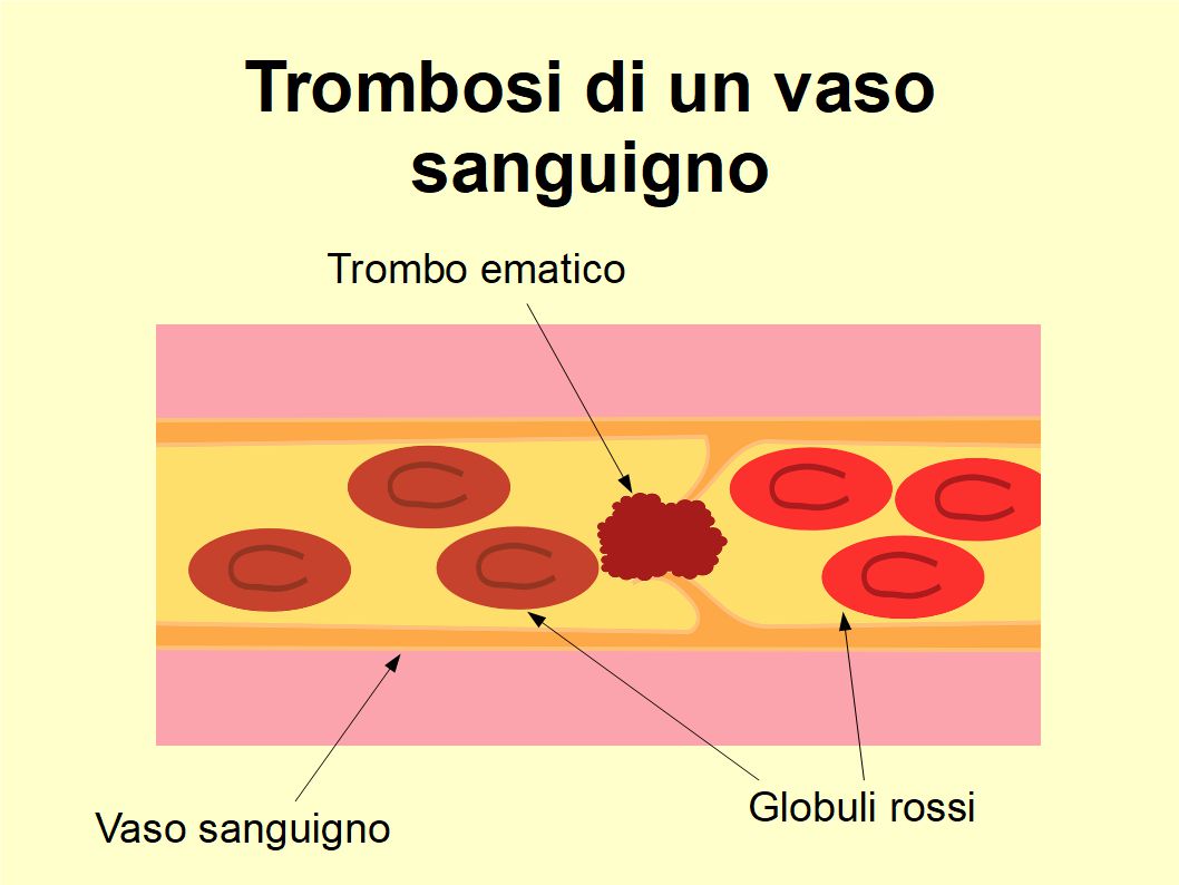 Il consumo abituale di Extravergine aiuta a prevenire il trombo ematico