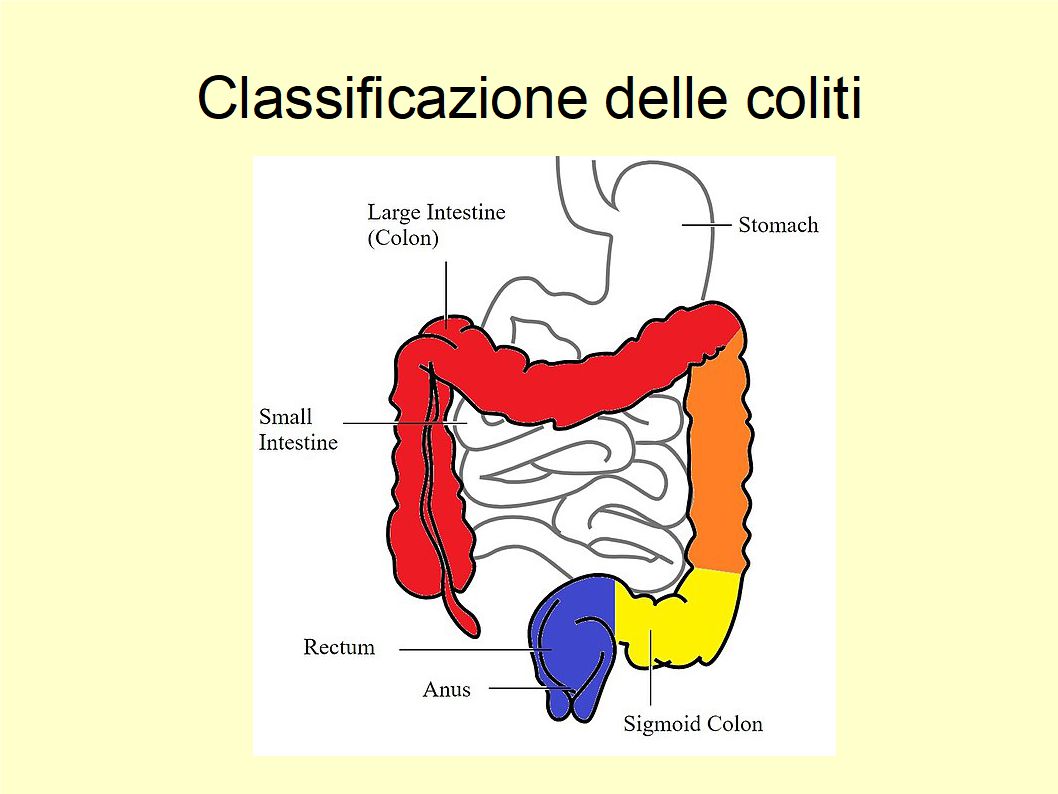 Solo l'Extravergine di Oliva contrasta la colite ulcerosa