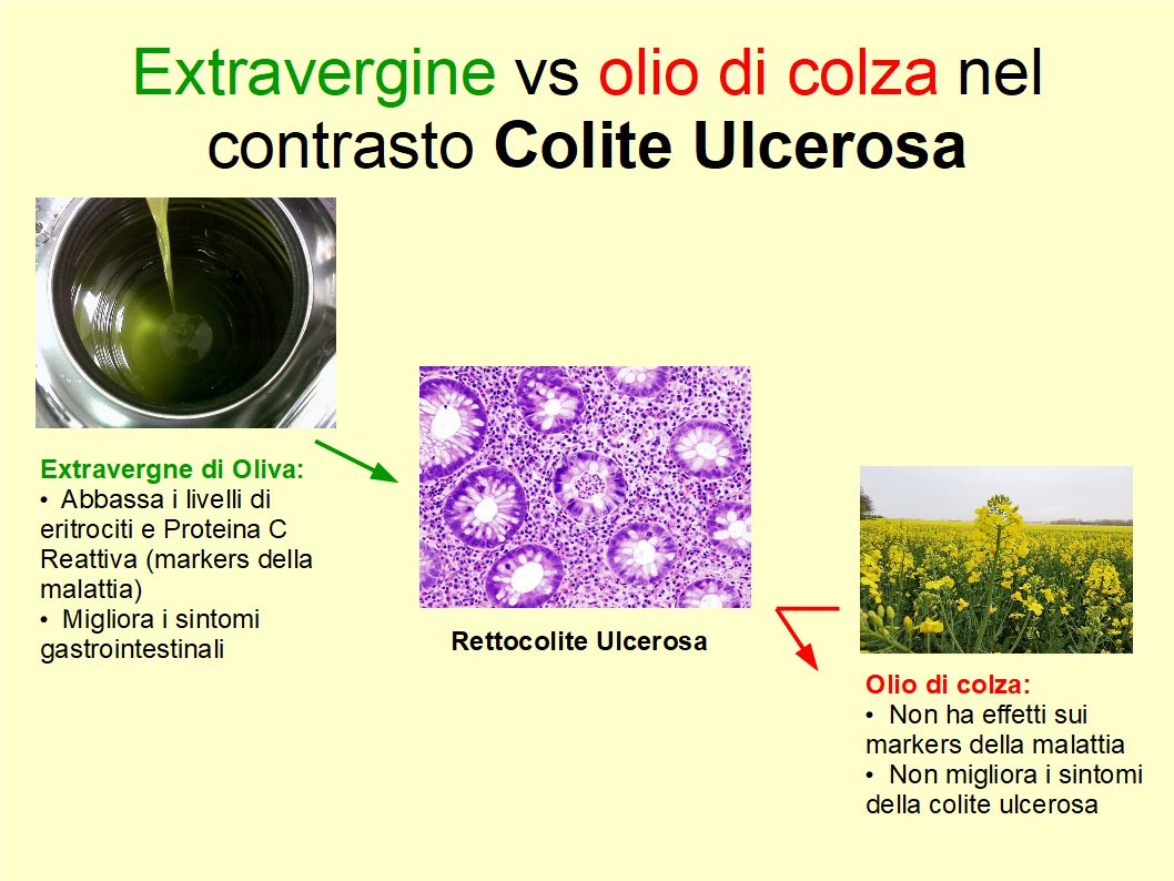 Solo l’Extravergine di Oliva contrasta la colite ulcerosa