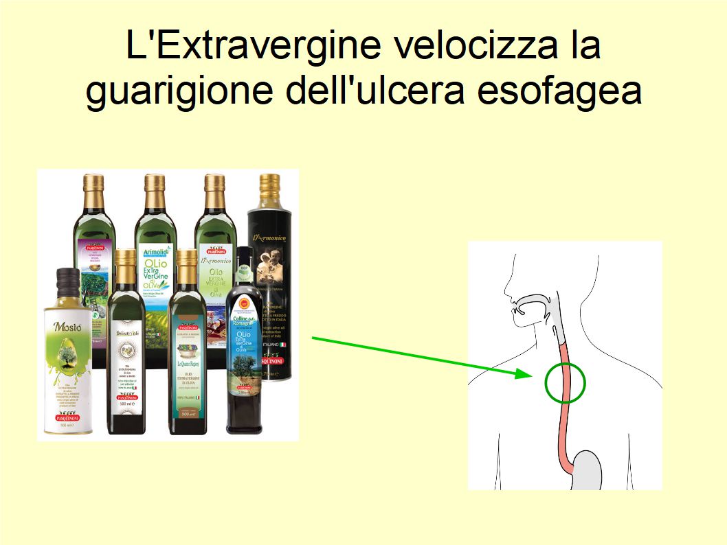 L’Extravergine velocizza la guarigione dell’ulcera esofagea